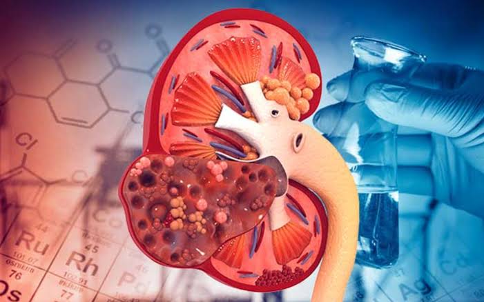 5 dấu hiệu suy thận sớm thường bị nhầm là do mệt mỏi, tuổi tác, người Việt  nên biết để phòng bệnh