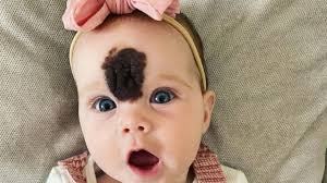 Znamię tej dziewczynki lekarze widzieli na USG. Nie zdecydowali się usunąć.  Dlaczego?