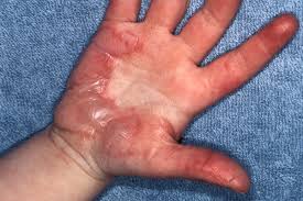 A deep partial thickness burn is more severe. When To Treat Or Refer A Burn Injured Patient Clinical Advisor