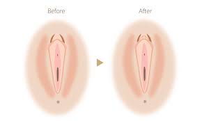 クリトリス包茎術 | ニキビ治療の実績多数｜セイコメディカル福岡院 美容皮膚科 美容外科