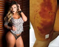 Check spelling or type a new query. Apos Nova Cirurgia Andressa Urach Permanece Internada Em Estado Grave