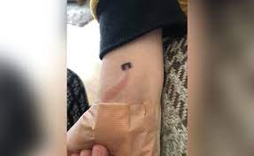 Early identification and treatment of sepsis non red flag septic shock type clinical line register no 130. Mom Says 8 Year Old Son Seemed Healthy Warns Parents About The Red Stripe On His Wrist