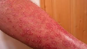 Image result for psoriasis