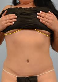 A Reverse Abdominoplasty Or Reverse Tummy Tuck Is A Cosmetic Surgical Procedure To Remove Excess Skin From The Tummy Tucks Tummy Tuck Cost Tummy Tuck Surgery