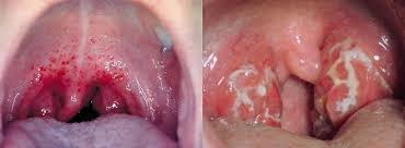 Image result for Strep throat infection roof of mouth