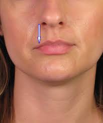 But there are a few key steps that patients can take if they want to ensure that the results from their treatment will not. Juvederm Permanent