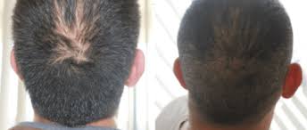 Because of links to male hormones, it is referred to as androgenic alopecia the gene. Treatment Of Hair Loss In San Antonio Boerne By Top Hair Specialists