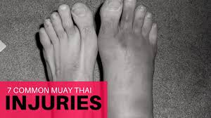 We look at the common causes, symptoms and treatment options for top much of the time, pain on top of the foot will settle down, using simple home treatments, within a week. Common Muay Thai Injuries And Remedies
