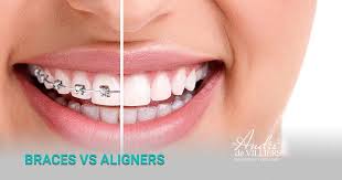 Invisible Vs Metal Braces Which Perform Best Metal Braces Clear Braces Clear Braces Vs Metal