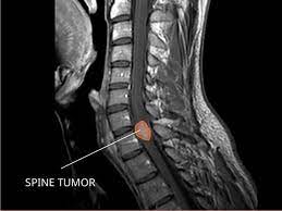 Spinal tumor pain may feel like one or more of the following: Ependymoma Diagnosis And Treatment National Cancer Institute