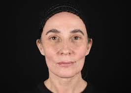 Dr Darren McKeown: Cosmetic Surgery, Botox & Fillers Glasgow