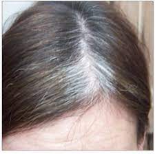Do you want the best ayurvedic medicines for treating premature hairs? Grey Hair Treatment Services In Pune Tukaram Paduka Chowk By Hairdoc Id 19157597155
