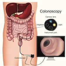 Here's when you need it, and when you might not. What To Expect When You Have A Colonoscopy The Ibs Dietitian