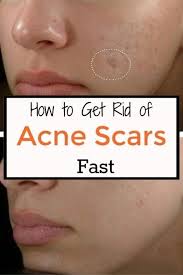Acne scars are the result of inflamed blemishes on the skin, according to the american society of dermatological surgery. Pin On Beauty Tips