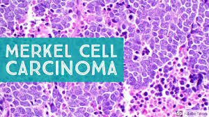 Image result for Merkel Cell Carcinoma