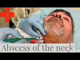 Infection In The Neck Gets Drained Youtube
