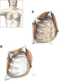 The breast reconstruction benefit does not include coverage for any of the following: Poland Syndrome Seminars In Thoracic And Cardiovascular Surgery