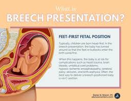 Image result for Breech Delivery