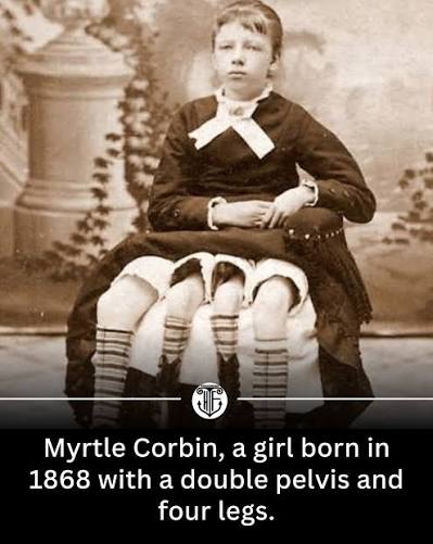Josephine Myrtle Corbin, the girl who was born with 2 pairs of legs due to  a rare condition called dipygus (1868–1928).