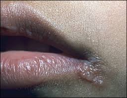 Herpes is separated into two types: Nongenital Herpes Simplex Virus American Family Physician