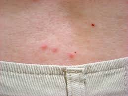 Image result for bedbugs bites