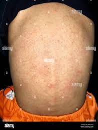 Image result for sweat rash on back