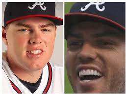 Freddie Freeman Veneers Before and After: Did Cosmetic Dentistry Go Too  Far?