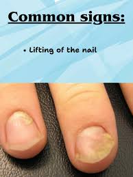 Image result for Pitting nails feet
