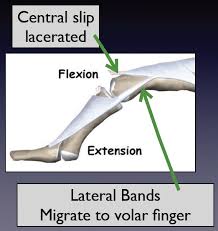 Image result for Elson Extensor Tendon Test