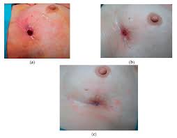 However, as with other types of cancer,. Jcm Free Full Text A New Therapeutic Application Of Platelet Rich Plasma To Chronic Breast Wounds A Prospective Observational Study