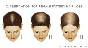 Androgenetic alopecia can start as early as the teens for men. Women Hair Loss Ilht Dubai