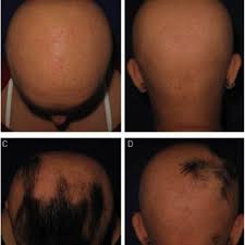 Image result for Anthralin