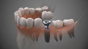 Dental Implants Aftercare | Healing, Hygiene & Long-Term Tips - Tooth Club