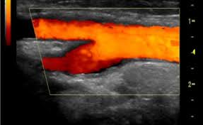 It helps doctors assess the blood flow through major arteries and veins, such as those of the arms, legs, and mycigna makes it easy. Vascular Ultrasound
