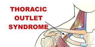 Thoracic Outlet Syndrome Samarpan Physiotherapy Clinic Ahmedabad