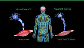 Muscle cramps and twitching in your arms, shoulders and tongue 7. Amyotrophic Lateral Sclerosis Als Physical Therapy Clinic Miami Aventura