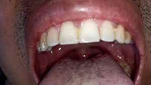 Check spelling or type a new query. My Uvula Infection And Canker Sore How To Cure Any Home Remedy Can Cure It Youtube