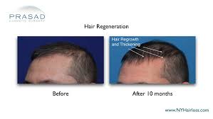 A dermatologist is a doctor who is trained to diagnose conditions that affect our skin, hair, and nails. Patient Case Studies Of Hair Regeneration Prasad Cosmetic Surgery