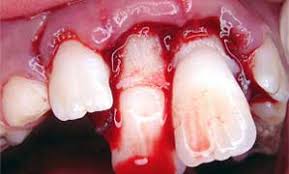 Image result for Tooth Luxation