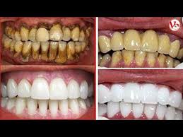 In 3 Minuti I Denti Gialli Brilleranno Come Una Perla Sbiancamento Dei Denti Con La Sbiancamento Dei Denti Sbiancamento Naturale Dei Denti Pulizia Dei Denti