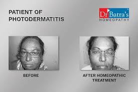 The selection of treatment is based on the extent of hair loss, grade of baldness as well as condition of the hair and the scalp. Dr Batra S Healthcare Gynaecologist Obstetrician Doctors Book Appointment Online Gynaecologist Obstetrician Doctors In Telibandha Raipur Chhattisgarh Raipur Chhattisgarh Justdial