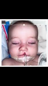 On-table incomplete cleft lip repair. , Even though this little beauty had  a relatively minor cleft at a glance, it’s important to consider the nose  and septum as well. My hope is that by ...