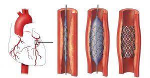 Na coluna de hoje, a cardiologista da unimed vale do são francisco, elisandra de sousa alves, fala sobre o infarto agudo do miocárdio, uma das doenças mais perigosas ligadas ao coração. Angioplastia No Tratamento Do Infarto Agudo Do Miocardio Hospital Sos Cardio