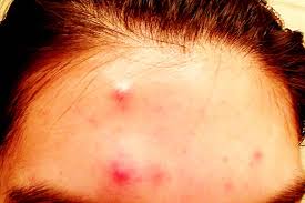 How To Get Rid Of Painful Pimples Fast Redness Pimple Painful Pimple Best Acne Treatment