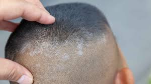 Scalp psoriasis is a somewhat rare scalp flaking condition that's different than dandruff and seborrheic dermatitis. Difference Between Psoriasis And Dandruff Man Matters