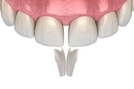 By covering the teeth, this acrylic acts to in some patients that do not place as much force on their teeth, a dental night guard can last over 10 years. Bonding Cosmetic Dentistry Dental Health Associates Madison