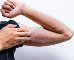 Image result for syphilis symptoms