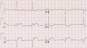 Occasionally patients have physiologic qs which are normal and do not signify infarction. Q Wave Litfl Ecg Library Basics