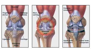Ceasing Aggressive Physical Therapy After Total Knee Replacement Total Knee Replacement Knee Replacement Knee Replacement Surgery Recovery