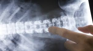 Spurs can take on a few different meanings. Treatment For Lower Back Pain Caused By Bone Spurs